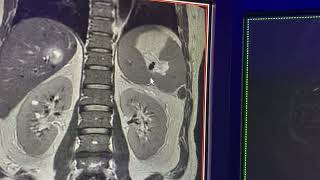 Coledocolitiasis conducto hepatico derecho aberrante y cistico con inserción baja [upl. by Ymme]