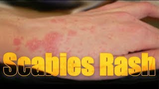 Scabies Rash itchy highly contagious skin disease  Usapang pangkalusugan [upl. by Winzler160]