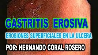 GASTRITIS EROSIVA  EROSIONES SUPERFICIALES EN LA ULCERA [upl. by Atirehgram]