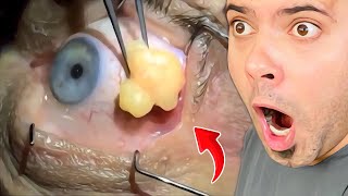 Popping huge blackheads and Giant Pimples Best Pimple Popping Videos [upl. by Mercado]