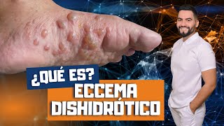 QUE ES LA DISHIDROSIS  ECZEMA DISHIDROTICO  COMO TRATAR EL ECCEMA DISHIDROTICO  DAVID CAMPOS [upl. by Samul]