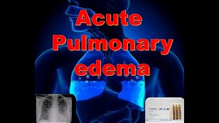 pulmonary edema in Emergency كيفية التعامل مع حالات الارتشاح فى الاستقبال [upl. by Koller709]