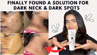 Dark neck amp Hyperpigmentation treatment  Acanthosis Nigricans treatment [upl. by Nastassia581]