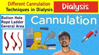 AVF Cannulation Techniques Explained A Dialysis Guide [upl. by Einnaoj]