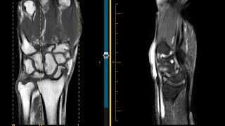 DISI and SLAC wrist scapholunate ligament tear and tenosynovitis [upl. by Gemina263]