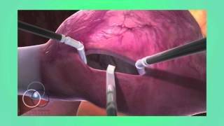 Atrial Septal Defect Repair at SSM Heart Institute [upl. by Stearn184]