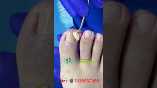 Caso de FIBROMA Solución definitiva satisfying ingrowntoenailsurgery [upl. by Narrat104]