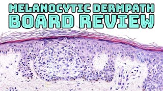 Melanocytic Dermpath Board Review melanoma blue nevus other nevi amp mimics pathology dermatology [upl. by Gabrielli]