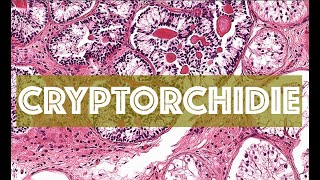 LA CRYPTORCHIDIE  PATHOLOGIE [upl. by Agle]