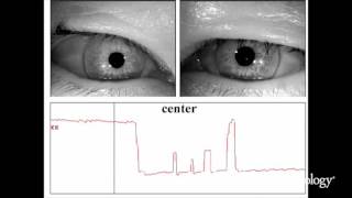 Nucleus prepositus hypoglossi lesions produce a unique ocular motor syndrome 12 [upl. by Asiul]