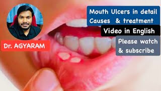 Mouth Ulcers Video  Mouth Ulcers Cause amp Treatment  How to prevent mouth ulcers doctor video [upl. by Aniri]