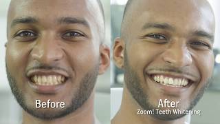 Philips Zoom teeth whitening treatment by mydentist [upl. by Laresa945]