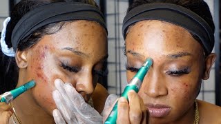 Microneedling at Home  Acne Scars Dark Spots Hyperpigmentation ft Dr Pen A6S [upl. by Garnette]