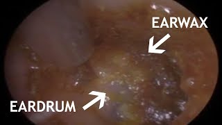 EARDRUM EAR WAX REMOVAL  STEADY HAND PREREQUISITE  439 [upl. by Lodi]