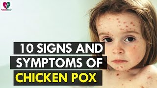 10 Signs and Symptoms of Chicken Pox  health Sutra [upl. by Allerus]