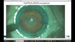 CAPSULASER Procedure [upl. by Dami]