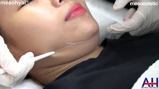 MESOHYAL  HƯỚNG DẪN KỸ THUẬT TIÊM GIẢM MỠ NỌNG CẰM  MESOESTETIC double chin removal  mesohyal [upl. by Yartnod921]