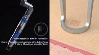 Qfit  Premium Qswitched Nd YAG Laser by Hironic [upl. by Gean]