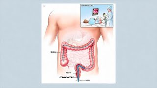 ¿Cómo se realiza una colonoscopia y una gastroscopia [upl. by Gerfen762]