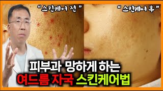 집에서 여드름 자국 없애는 방법 자가관리로 여드름자국 없애는법아크네마인드 여드름닥터가 알려드립니다 [upl. by Elnar449]