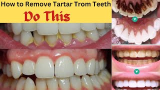 How to Remove Tartar from Teeth Naturally  Remove Dental Plaque and keep Oral Hygiene Healthy [upl. by Alyosha]