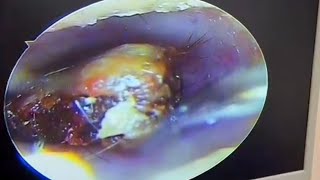 Cleaning of oversized external auditory canal cholesteatoma earwax Cleaning earwaxremoval [upl. by Paff461]