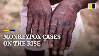 What is monkeypox and should we be worried that it’s spreading [upl. by Anotal]