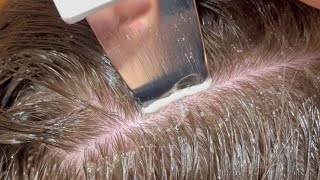 Scalp Treatment for DandruffBuildup [upl. by Constancia]