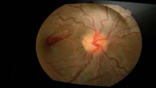 Yag Laser Hyaloidotomy for a pre macular haemorrhage [upl. by Fermin894]