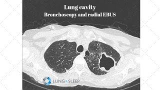 Lung cavity  Bronchoscopy with radial endobronchial ultrasound EBUS [upl. by Nymrak]