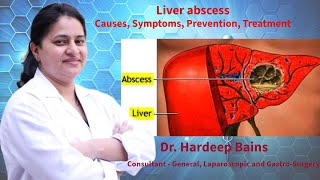 Liver abscess  लिवर एब्सेस रोग क्या है  यकृत फोड़ा  Dr Hardeep Bains [upl. by Iny]