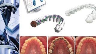 ORTODONCIA LINGUAL  CEMENTACIÓN INDIRECTA DE BRACKETS LINGUALES 2D Forestadent [upl. by Tlevesor]