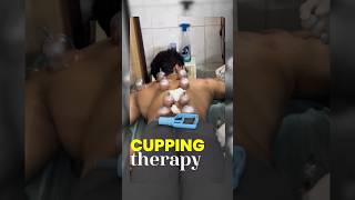 Cupping Therapy Cost 😳 amp Benefits 🙂‍↕️ [upl. by Picco321]