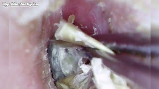 Ear Wax Removal 110 Itching All Day Because Of Dry And Thick Earwax  Ear Cleaning ASMR [upl. by Sylvan974]