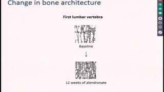 Osteoporosis 101 Basic Concepts in Osteoporosis Diagnosis amp Biphosphonates 41019 [upl. by Garrik762]