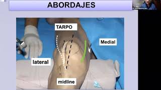 Webinar MIO en fémur distal indicaciones técnica y complicaciones [upl. by Rechaba]