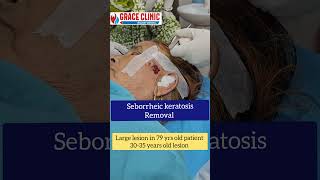 Seborrheic keratosis removal  Grace clinic Dehradun  Dr Naziya khatun [upl. by Mcclain]