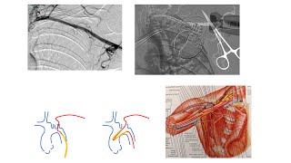 Axillary balloon pump Impella stepbystep access exchange closure complications Elias Hanna [upl. by Aryamo]