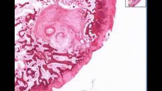 Histopathology BoneOsteoarthritis subchondral cyst [upl. by Starobin38]