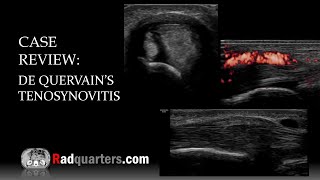 Ultrasound of de Quervain’s Tenosynovitis [upl. by Ortrud660]