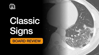 Classic Signs  Chest Radiology Board Review [upl. by Ekeiram240]