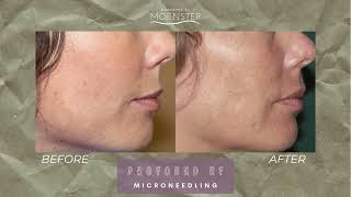 Profound RF Microneedling Benefits [upl. by Mor568]