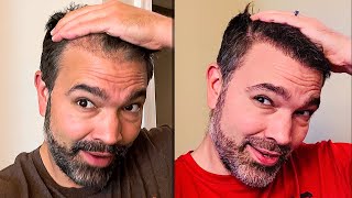 Cajun Ninja FUE Hair Transplant 3 Months to 6 Months [upl. by Sabino100]