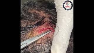 HEAD SUTURE REMOVAL  SUTURE KAISE NIKALE  SUTURE KAISE REMOVE KARE  SUTURE REMOVAL PROCEDURE [upl. by Nahguav]