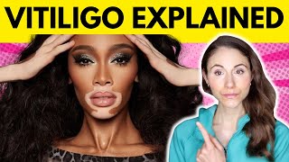 Vitiligo WHY YOU HAVE IT amp WHAT TO AVOID [upl. by Tita579]