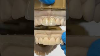 Central Zirconia Incisors EnvisiontecMain envisiontec lsk121shorts dentist [upl. by Refinnaj712]