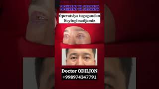 Qovoq olish  қовоқ олиш  blefaroplastika Doctor ODILJON 998974347791 TOSHKENT VA JIZZAXDA rek [upl. by Carr]