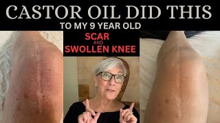 CASTOR OIL DID THIS TO MY 9YEAROLD SCAR AND SWOLLEN KNEE [upl. by Nashner]