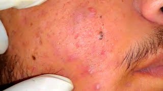 sac be spa blackheads elderly 2024  sac be spa old age blackheads 2024  sac be spa thuy 777 [upl. by Ttereve]