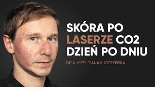 Laser CO2 na blizny  rekonwalescencja dzień po dniu [upl. by Yddub]